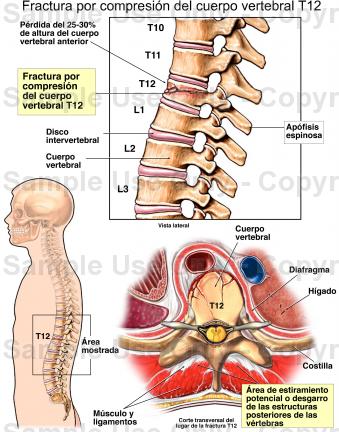 WSBK: Markus Reiterberger absen setelah Crash dengan Chaz Davies.. Patah Tulang..!! 1 AltheaRacing BMW Reiterberger tulang