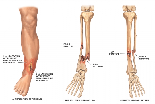 Valentino Rossi Kecelakaan Saat Latihan, Kini Jalani Operasi !! 1 Fibula tibia patah