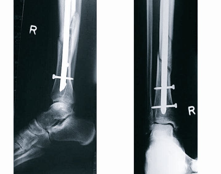 Valentino Rossi kaki patah 1