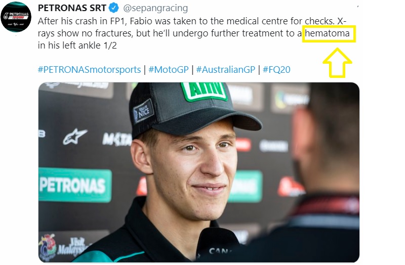 Update: Akibat Cedera dan Alami Hematoma, Quartararo Batal Ikut FP2 ! 2 Hematoma Fabio Quartararo
