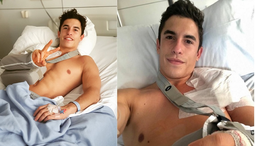Marquez Diragukan Bisa Turun di Tes Sepang, 2 Bulan Lagi? 3 Marc Marquez Penyembuhan Cedera bahu 1