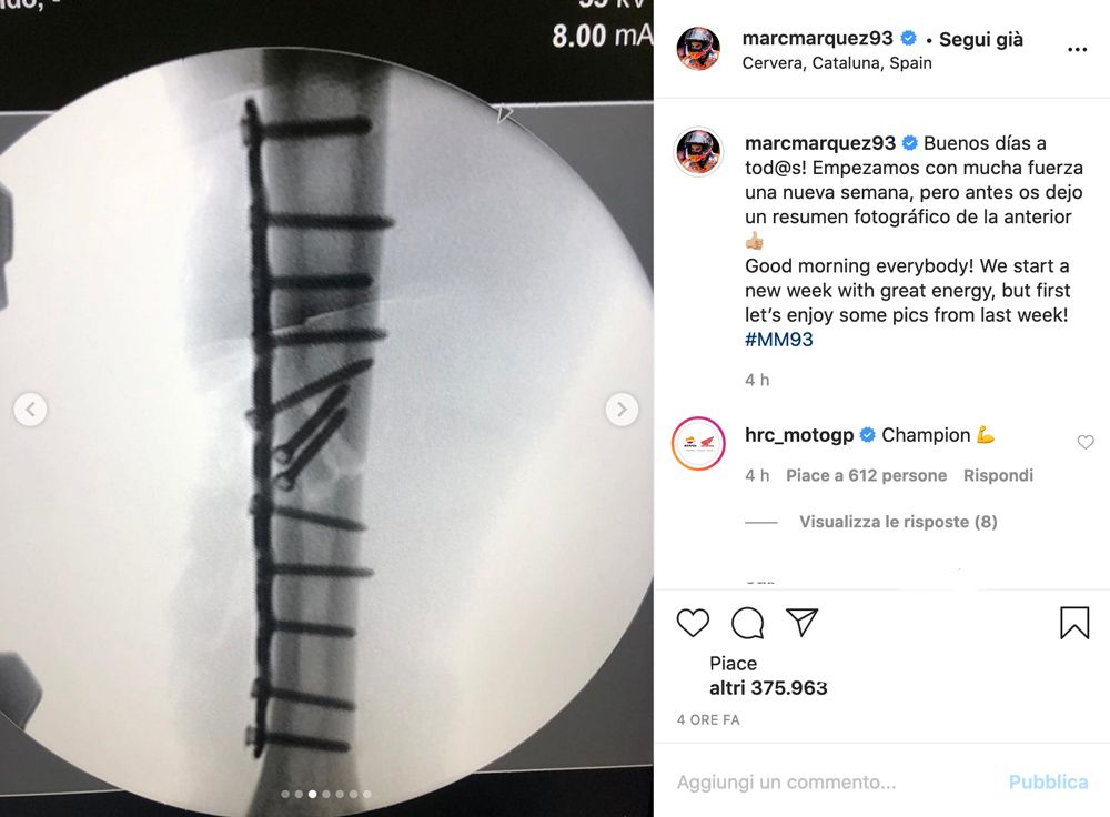 Alberto Puig: Tanpa Marc Marquez Balapan Akan Berbeda! 1 Marc Marquez Tulang Patah